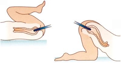 cum se face o clismă pentru prostatită bai de sezut pentru adenom de prostata